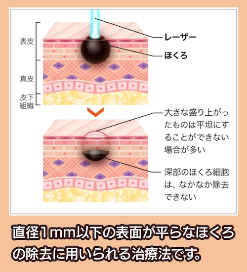 レーザー治療