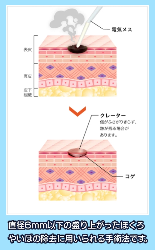 電気メスによる電気分解法