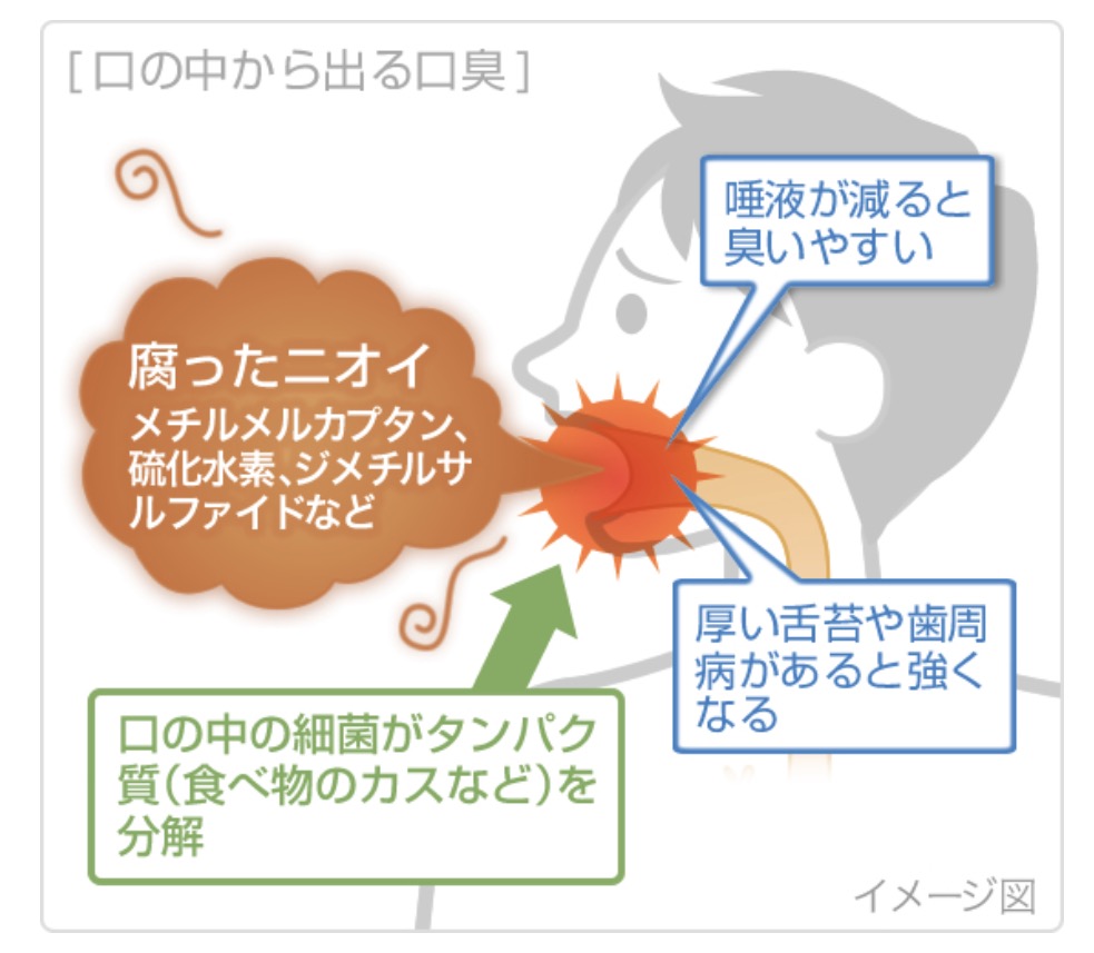 口臭の発生原因