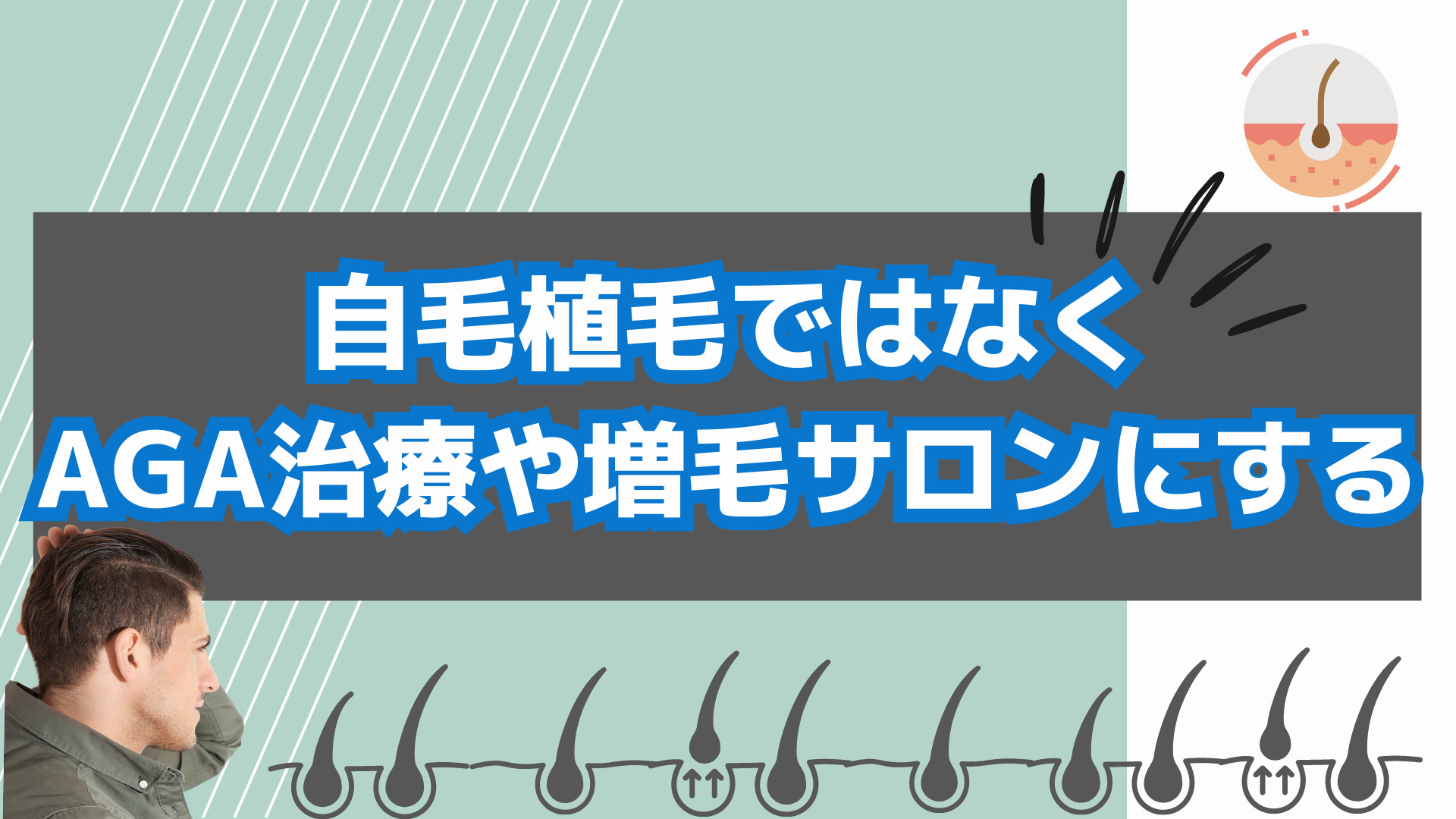 自毛植毛ではなくAGA治療にする