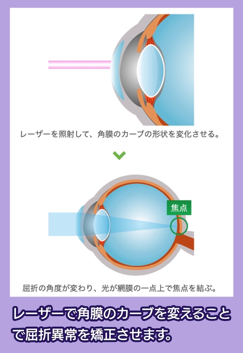 レーザーで角膜を削る