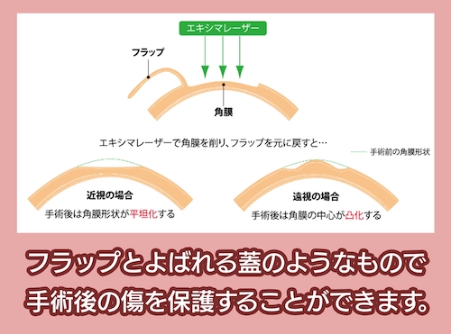 レーシック手術を横から見た図