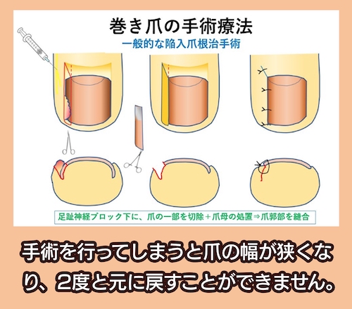 大木皮膚科 巻き爪の手術療法