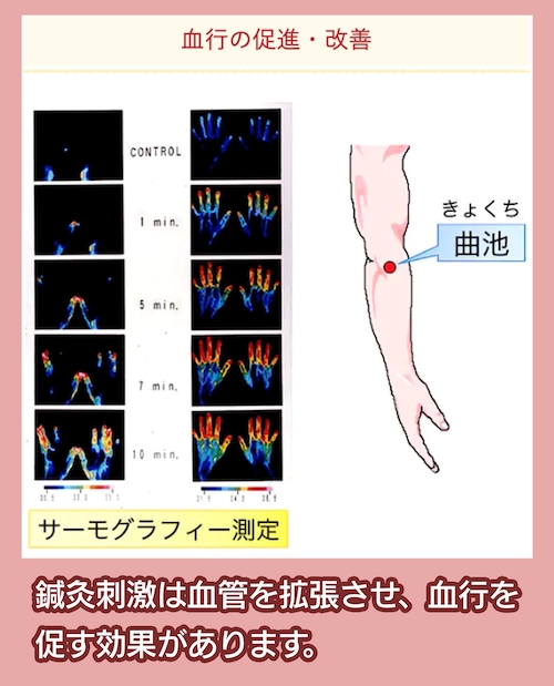 鍼灸院みらい京都桂 血行促進効果