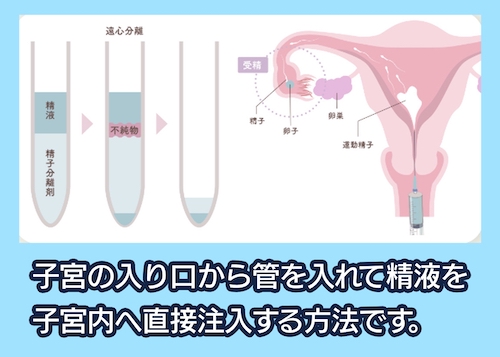 加藤レディスクリニック 人工授精