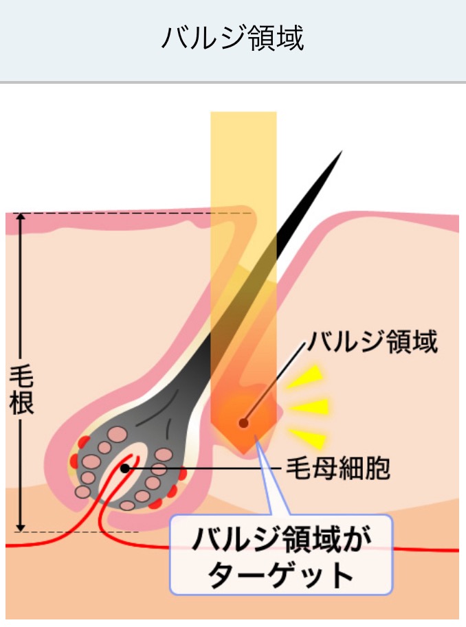 蓄熱式医療脱毛機の仕組み