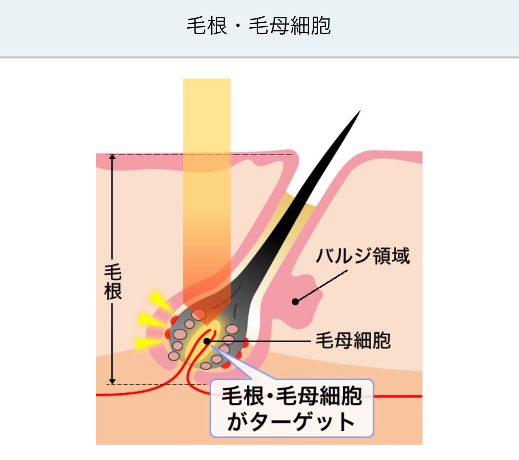 熱破壊式医療脱毛機の仕組み