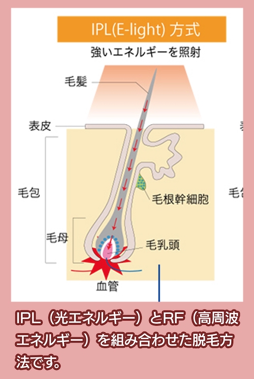 エステジャパン E-light方式光脱毛