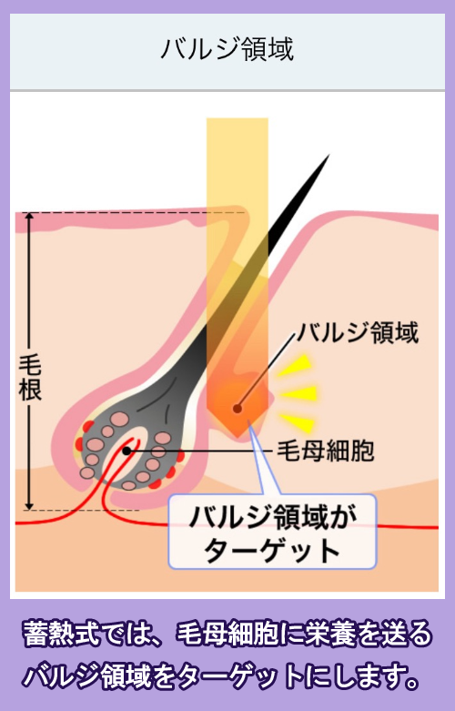 蓄熱式医療脱毛機の仕組み