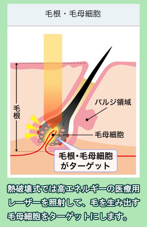 熱破壊式医療脱毛機の仕組み