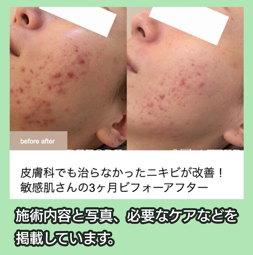 アロンジェ 施術事例