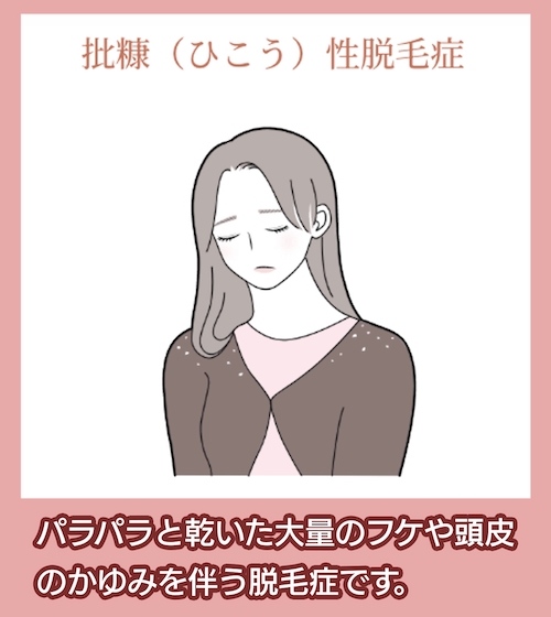 批糠（ひこう）性脱毛症